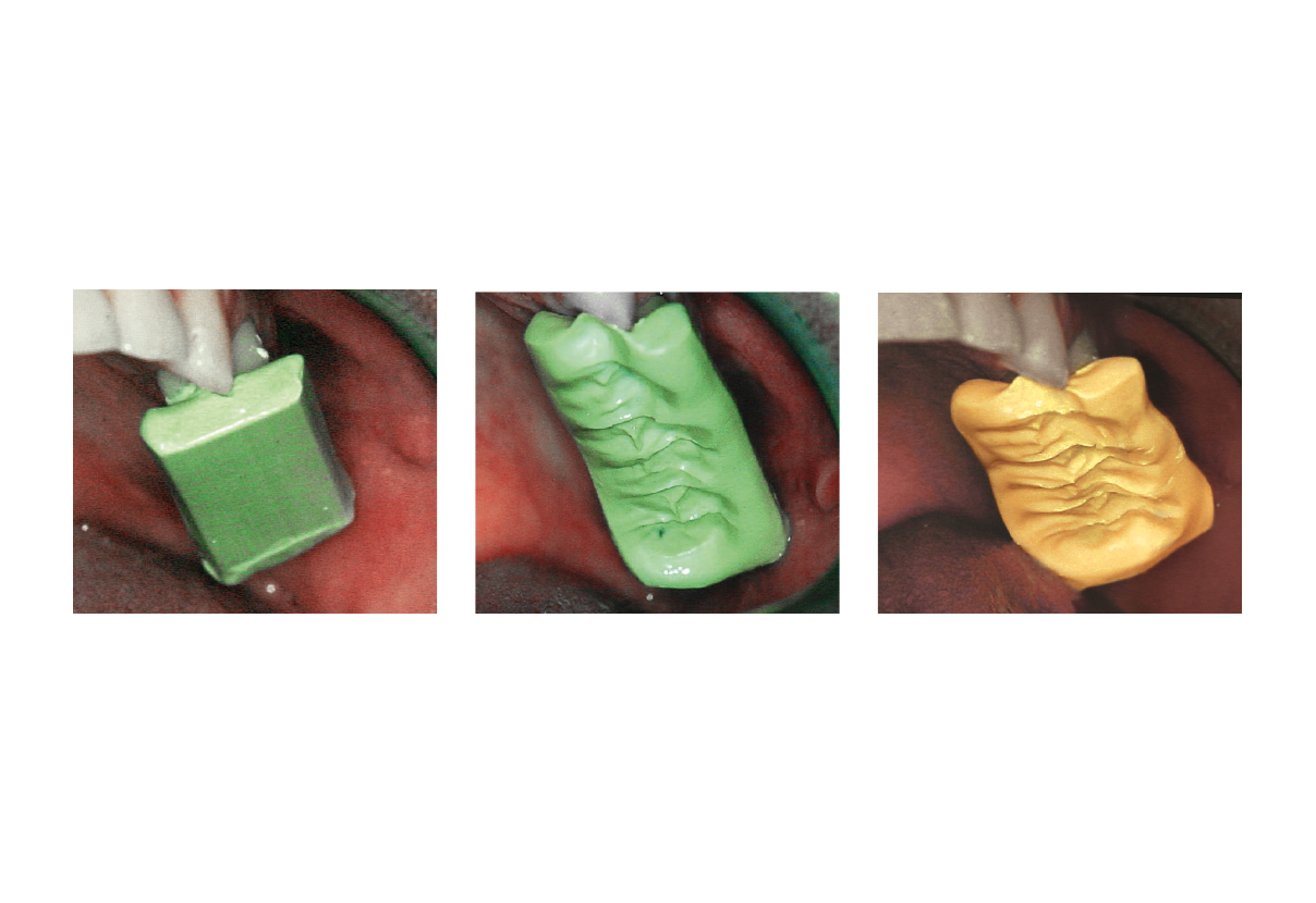 S-U-FGP-FUNKTIONSWACHS, Durchführung der aktiven und passiven Bissregistrierung